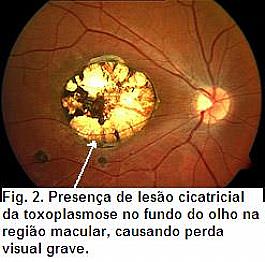 toxoplasmoza oculara)